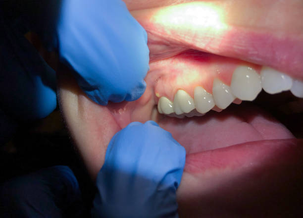 Best Dental Abscess Treatment in Notre Dame, IN